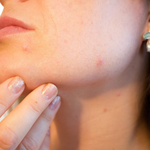 V případě akné je základní prevencí dostatečné,  ale nikoli nadměrné čištění pleti. | foto: Fotobanka Pixabay